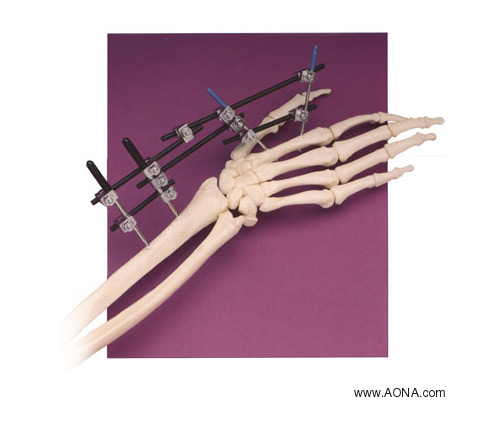 <b>Wrist Fixation System</b><span><br /> Designed by <b>Mark Estrada</b> for <b>Rigid Medical</b> • Created in Ashlar-Vellum Software</span>